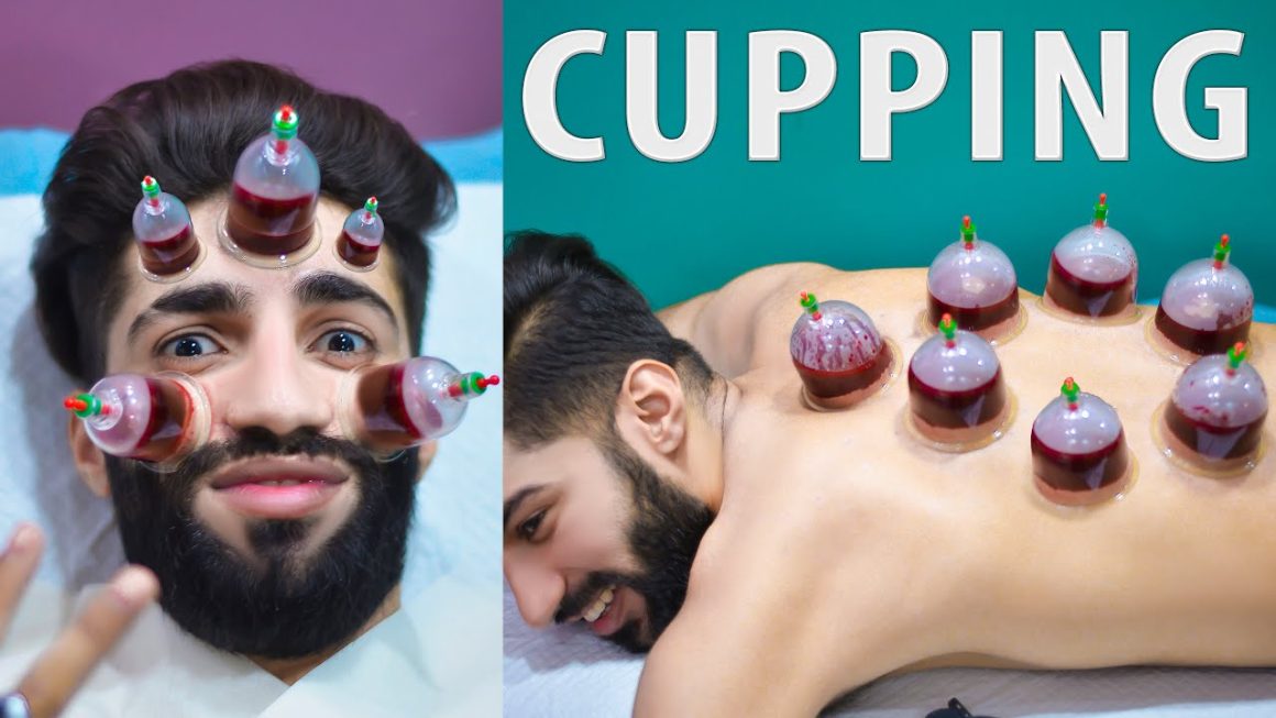 Hijama Cupping Therapy