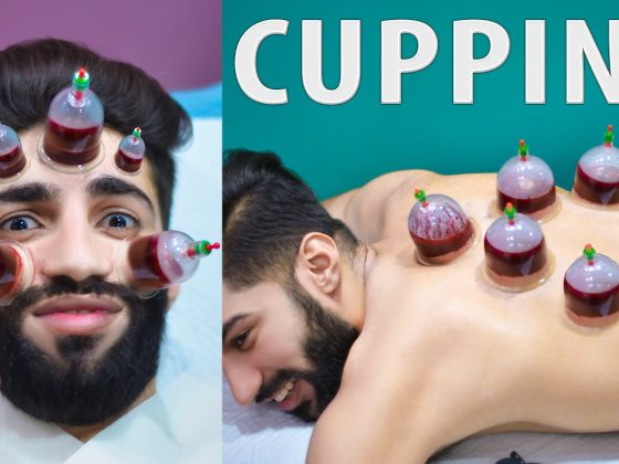 Hijama Cupping Therapy