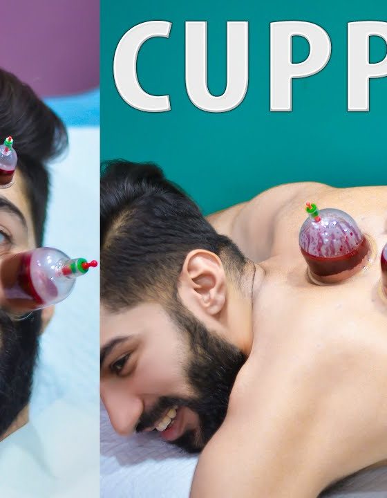 Hijama Cupping Therapy