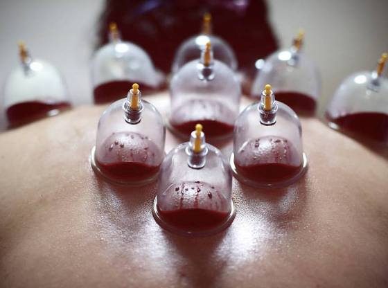 HIJAMA (VENTOUSE) Cupping Therapy