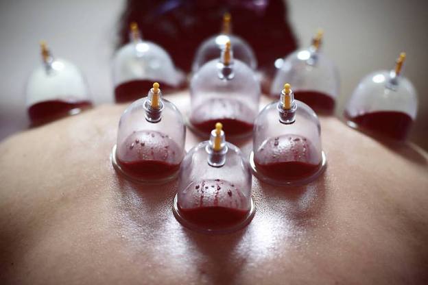 HIJAMA (VENTOUSE) Cupping Therapy