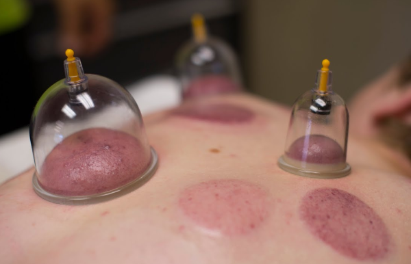 bien-être avec la hijama